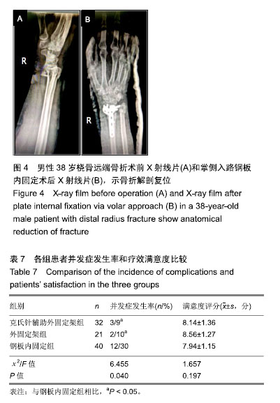 C型桡骨远端骨折患者腕关节功能及骨折复位质量 克氏针辅助外固定架 外固定架及掌侧入路钢板内固定的比较