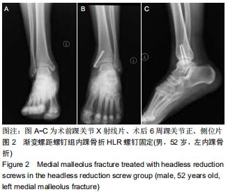 分段渐变螺距中空埋头加压螺钉和普通空心半螺纹加压螺钉治疗内踝骨折的